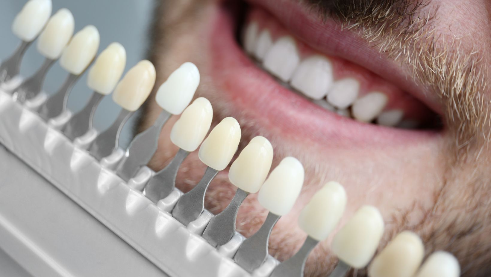 which of the following statements is correct concerning porcelain veneers?